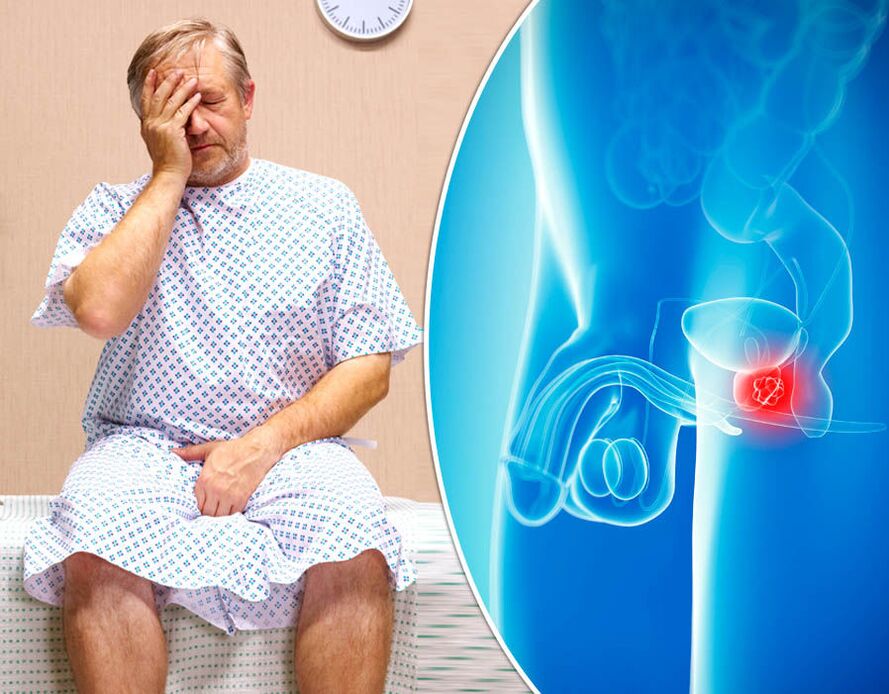 Man with prostatitis is diagnosed with the disease