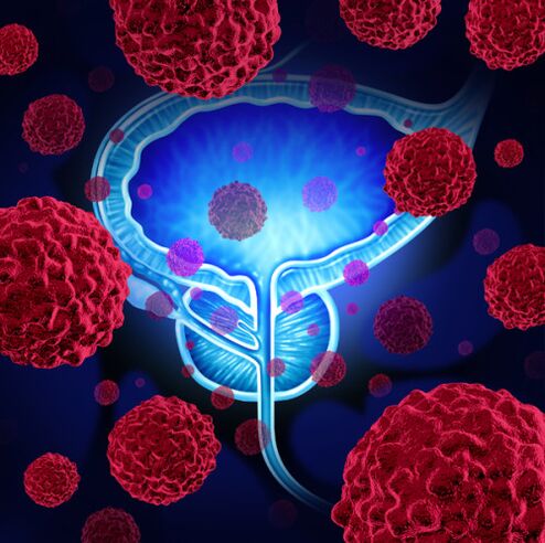 The activity of pathogenic microorganisms is the cause of the development of prostatitis