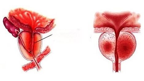 How is chronic prostatitis